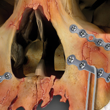 $1.1M Settlement: Illustrating Facial Fractures After Head-On Motorcycle Collision