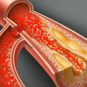 $1.67M Verdict: Animating How Mesenteric Ischemia Caused Abdominal Disaster