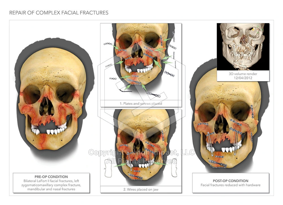 $1.1M Settlement: Illustrating Facial Fractures After Head-On Motorcycle Collision