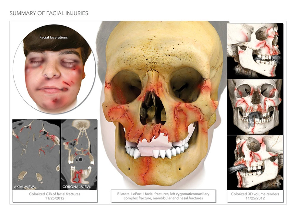 $1.1M Settlement: Illustrating Facial Fractures After Head-On Motorcycle Collision