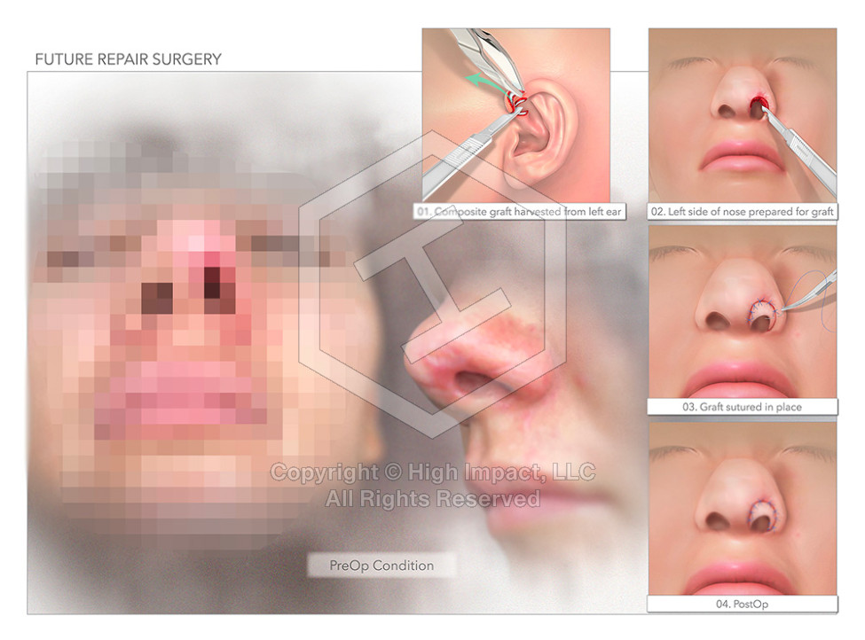 $1.3M Settlement on $0 Offer: Medical Illustrations of Woman Attacked by Dog Make a Huge Impact