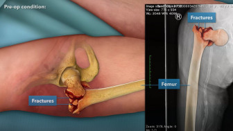 $1.684M Verdict: 2D Animation of Hip Surgery Helps Achieve A Successful Result