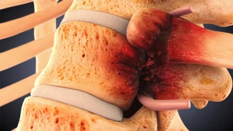 Personal Injury