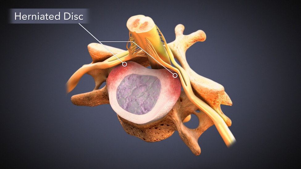 $2.25M Settlement on $8,700 Offer: Animating Cervical Disc Replacement