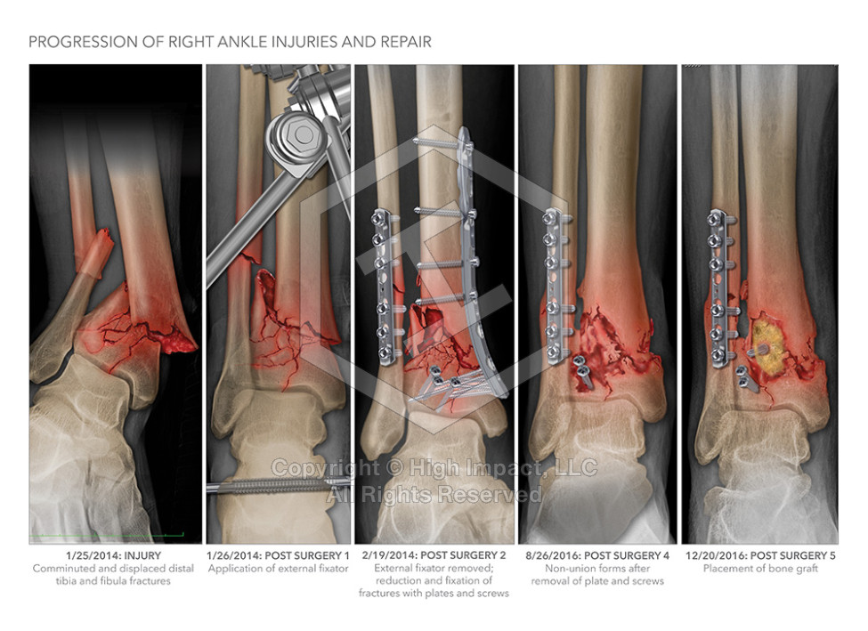 $2.4M Verdict: Illustrating Ankle Fractures After Drunk Driving Crash