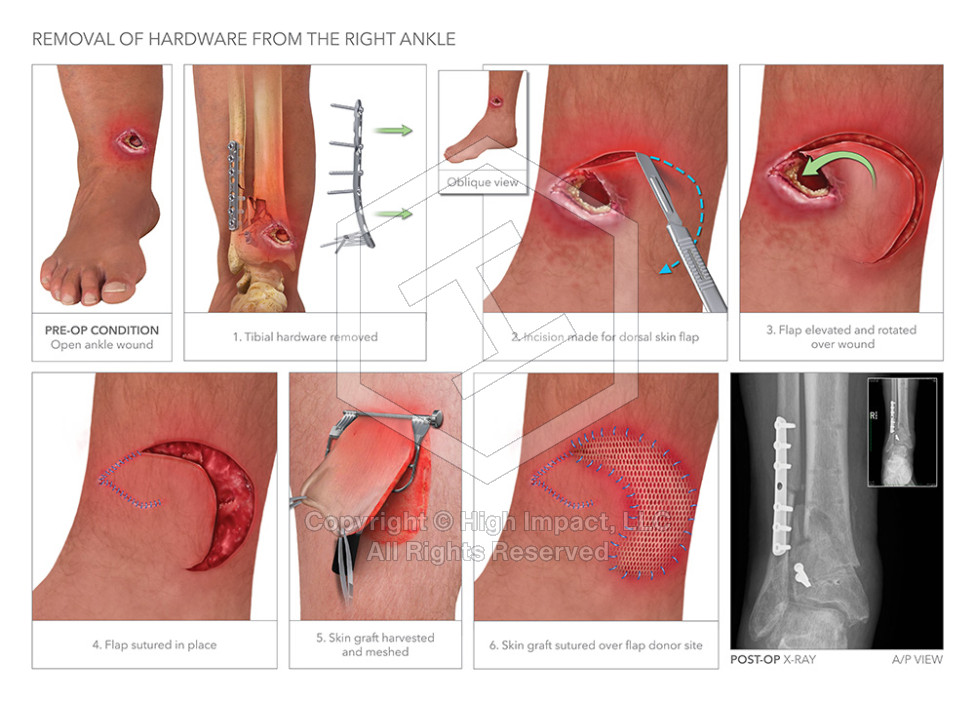 $2.4M Verdict: Illustrating Ankle Fractures After Drunk Driving Crash