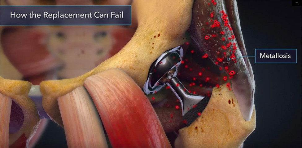 $21M Verdict: Animation Clearly Shows Damage from Defective Hip Implant