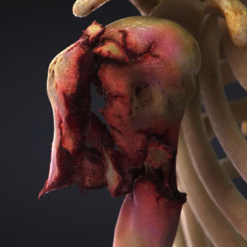 $2M Settlement: Animation Used in Demand Package: Woman Ejected from Golf Cart