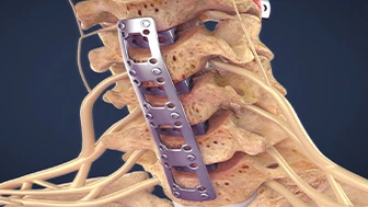 Personal Injury