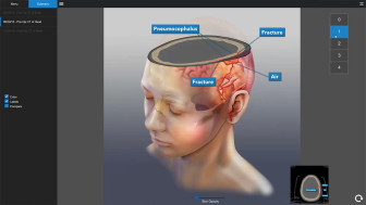 $4.5M Settlement Exposing 3D Depth of Skull Fractures and TBI