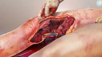 Personal Injury