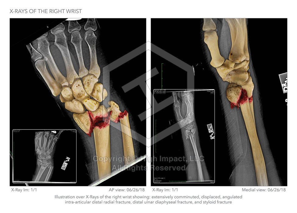 $525K Settlement: Illustrating Wrist Injury After Fall Down Stairs