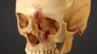 Personal Injury
