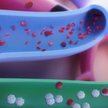 $6M Settlement: Animating Failure to Examine and Treat Malignant Melanoma