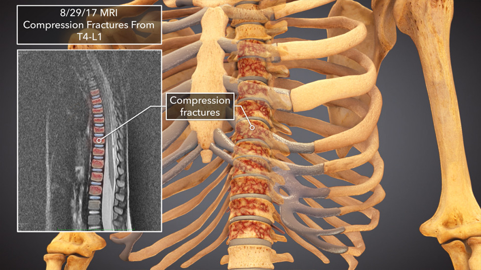 $7.3M Settlement: 3D Animating Catastrophic Fractures After Tree Limb Crushes Toddler