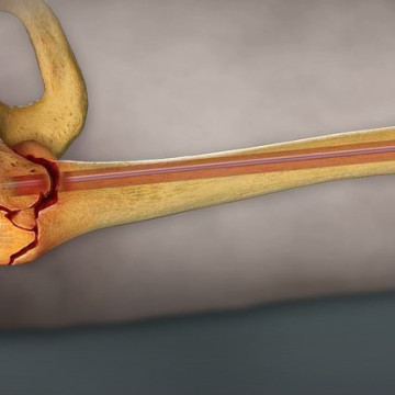 $1.684M Verdict: 2D Animation of Hip Surgery Helps Achieve A Successful Result