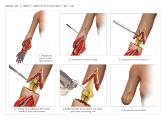 Above Elbow Amputation