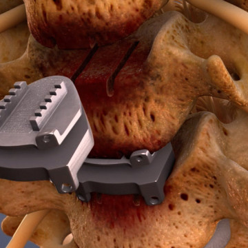 $2.25M Settlement on $8,700 Offer: Animating Cervical Disc Replacement