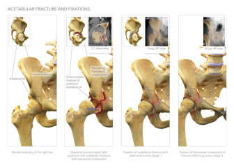 Acetabular Fracture and Fixations