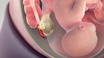 Acute Appendicitis During Pregnancy
