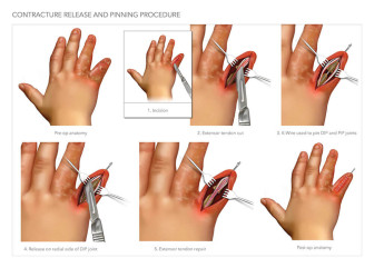 Amputation of Finger at PIP Joint