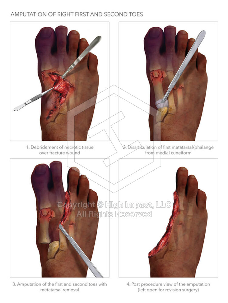Amputation of Right First and Second Toes