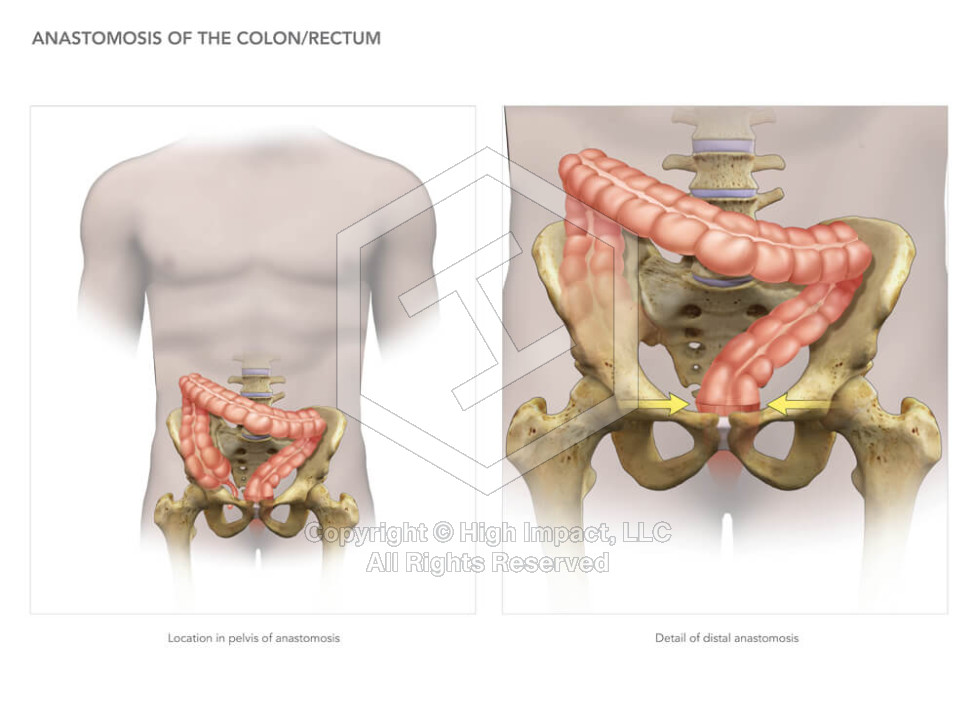 Anastomosis of the Colon/Rectum
