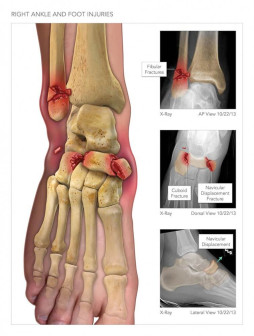Ankle and Foot Injuries