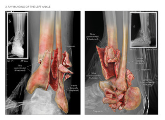 Ankle Fracture Illustration