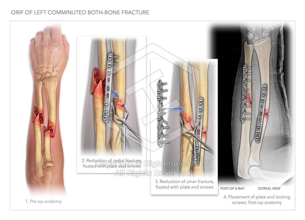 Arm ORIF Surgery Illustration