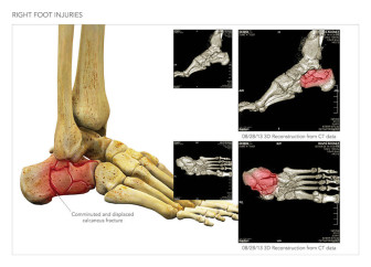 Bilateral Foot Injuries