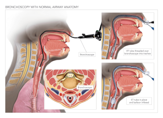 Bronchoscopy With Normal Airway Anatomy