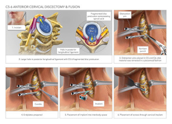 C5-6 Anterior Cervical Disectomy & Fusion