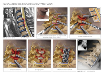 C5-7 Anterior Cervical Discectomy and Fusion