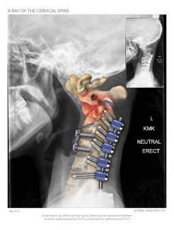 Cervical Fusion Illustration