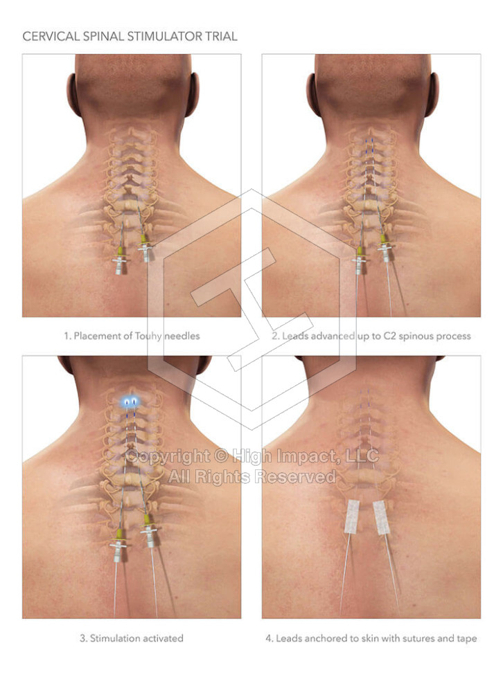 Cervical Spinal Stimulator Trial