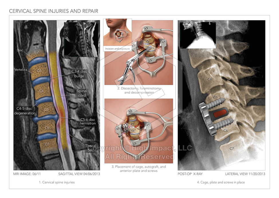 Cervical Spine Injuries & Repair