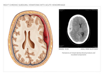 Chronic Subdural Hematoma with Acute Hemorrhage
