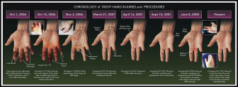 Chronology of Hand Injuries and Procedures