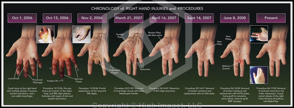 Chronology of Hand Injuries and Procedures