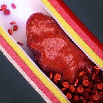 Animated still showing normal arterial blood flow and stroke