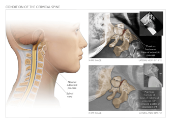 Condition of The Cervical Spine