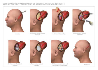 Craniotomy and Fixation of Occipital Fracture