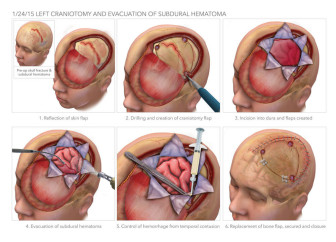 Craniotomy for Evacuation of Subdural Hematoma