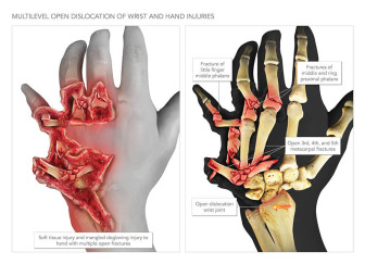 Dislocation of Wrist and Hand with Open Fractures