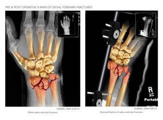 Distal Forearm Fractures