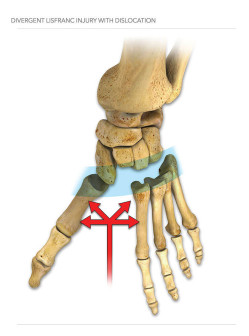 Divergent Lisfranc Injury with Dislocation
