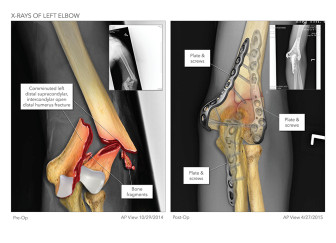 Elbow Fracture Illustration
