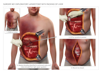Exploratory Laparotomy with Packing of Liver