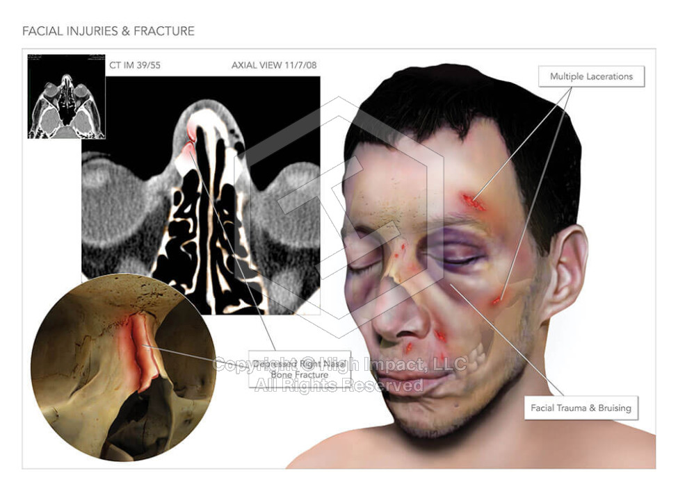Facial Injuries & Fracture